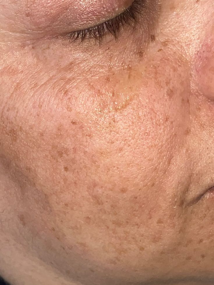 ¿Por qué me vuelve el melasma?