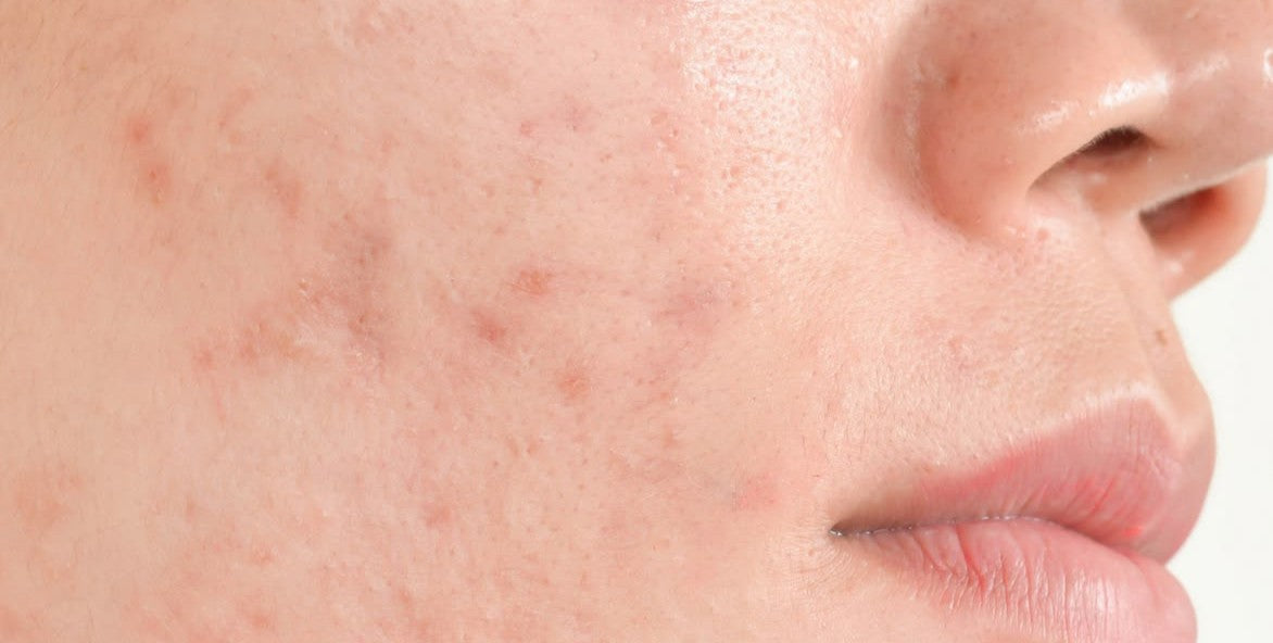 Tipo de marcas y manchas de acné: cómo identificarlas y tratarlas correctamente
