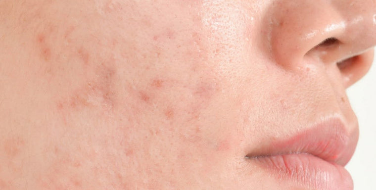 Tipo de marcas y manchas de acné: cómo identificarlas y tratarlas correctamente