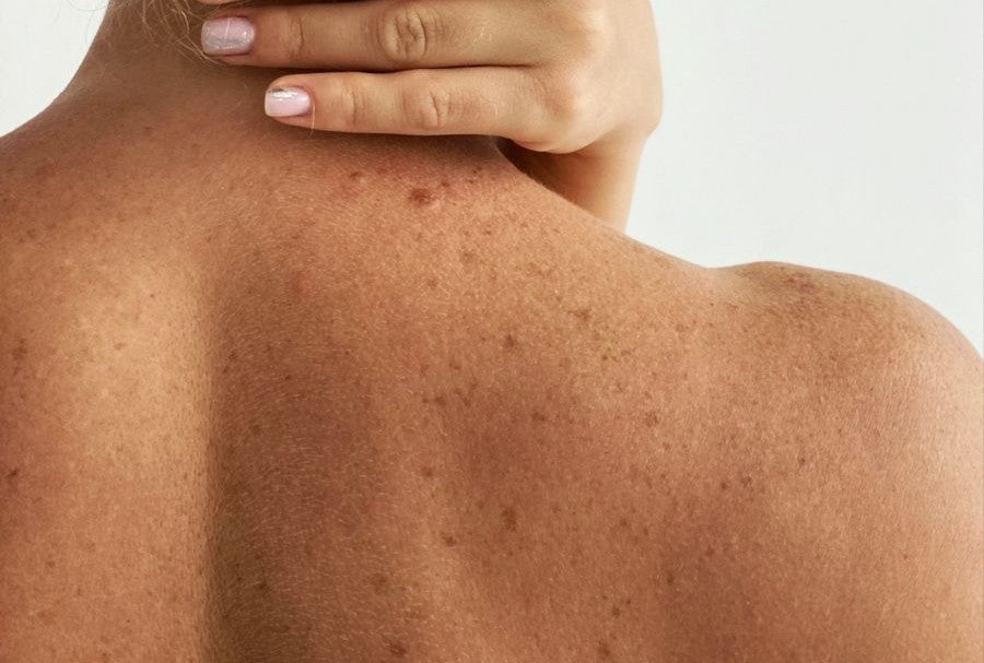 Tipos de manchas