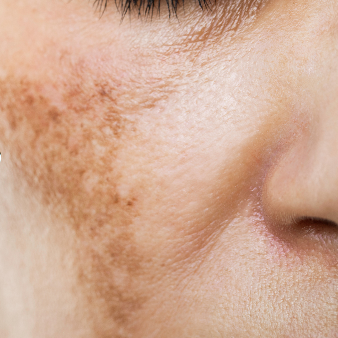 Manchas y melasma